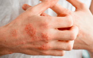 Treat Eczema