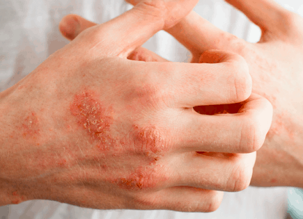 Treat Eczema