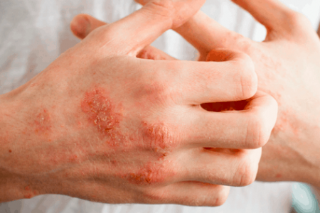 Treat Eczema