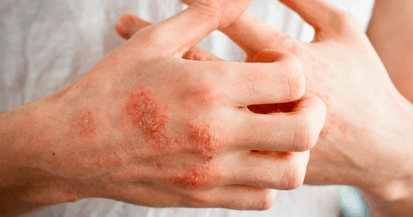 Treat Eczema