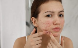 Cystic Acne Treatment