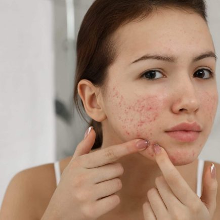 Cystic Acne Treatment