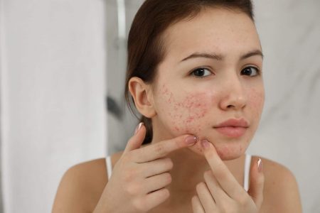 Cystic Acne Treatment