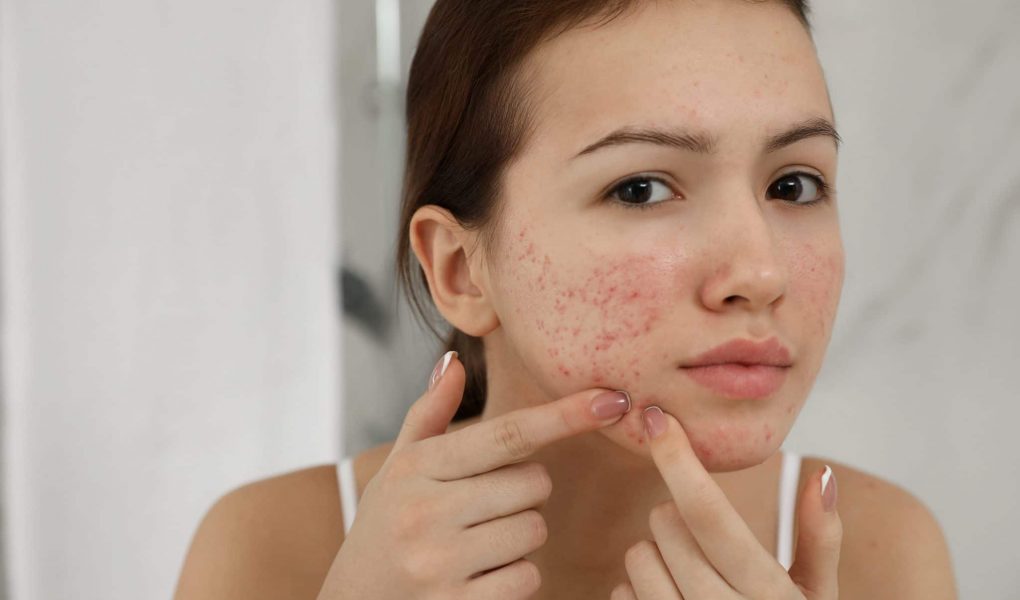 Cystic Acne Treatment