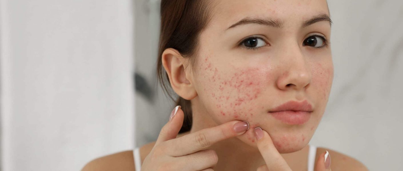 Cystic Acne Treatment