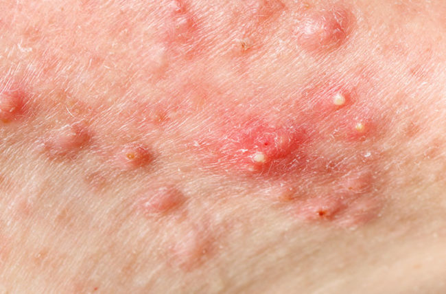 Cystic Acne